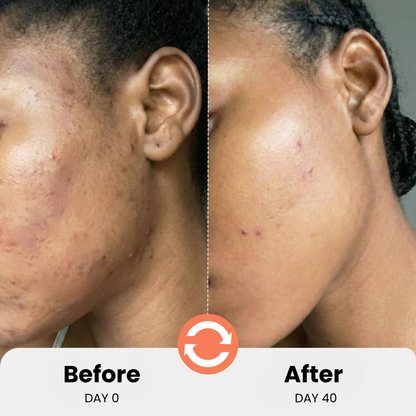 Blemish Control Serum